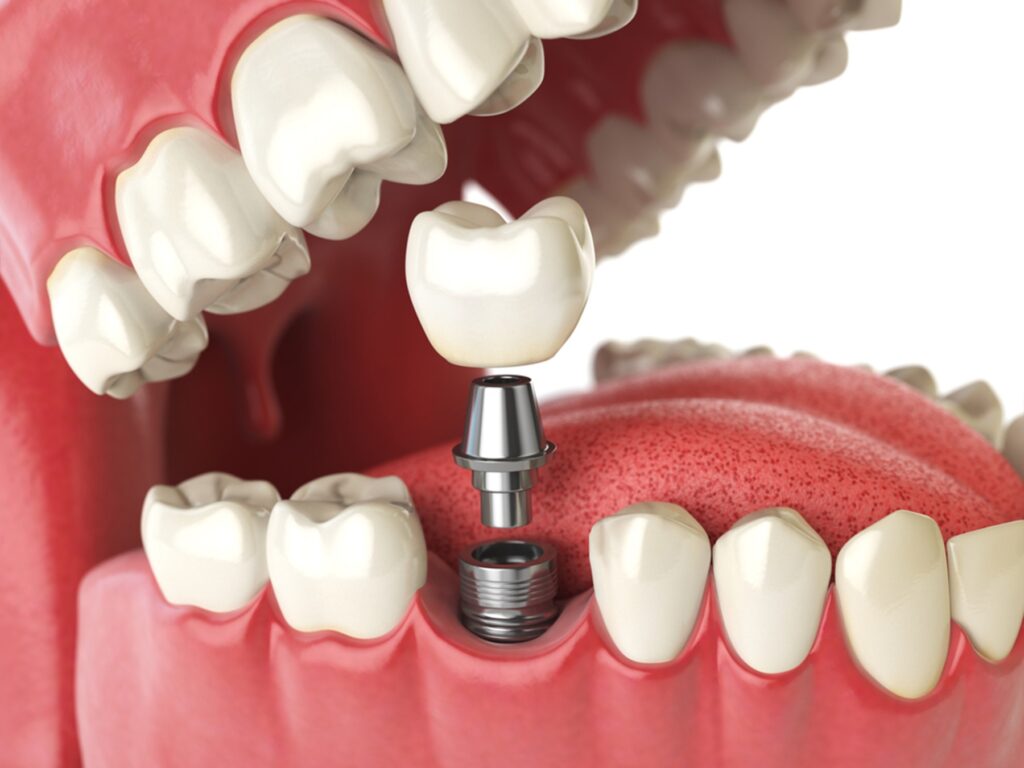 flagler fl, Facts About Dental Implants